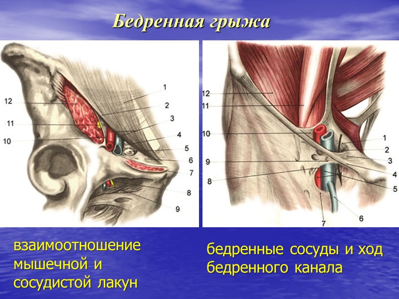 Бедренная грыжа взаимоотношение  мышечной и  сосудистой лакун бедренные сосуды и ход бедренного